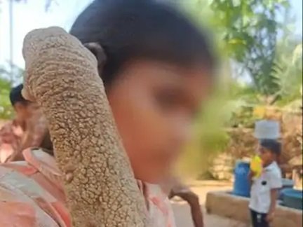 दुर्लभ बीमारी से जूझ रही जागेश्वरी की नई उम्मीद