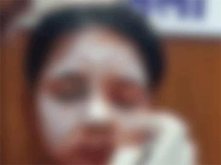 बालोद में युवती पर एसिड अटैक, हालत गंभीर